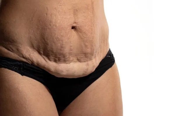 Lost the Weight but Not the Loose Skin? 1 image of womans stomach after weight loss showing loose skin Acocks Green